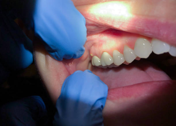 Best Chipped Tooth Repair Near Me  in Girardville, PA